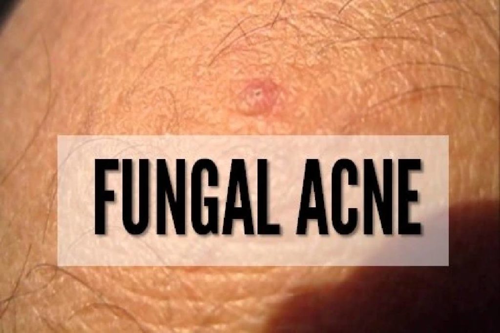 fungal acne