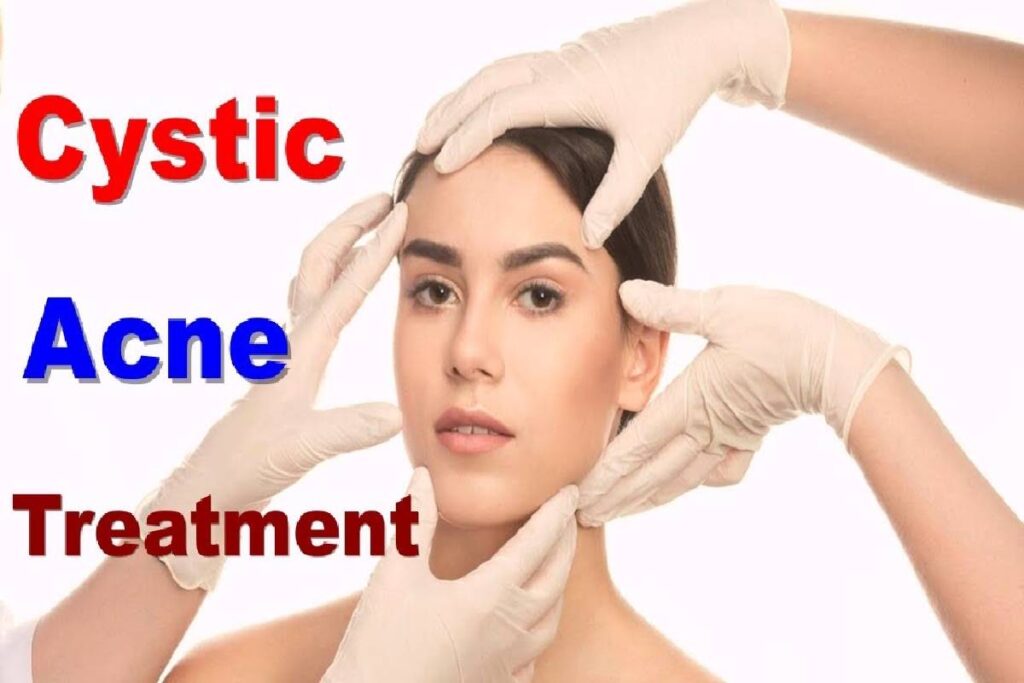 cystic acne treatment